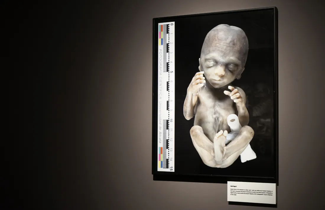 Fotografia mèdica: fetus afectat de llavi leporí mort a les 18 setmanes de gestació.