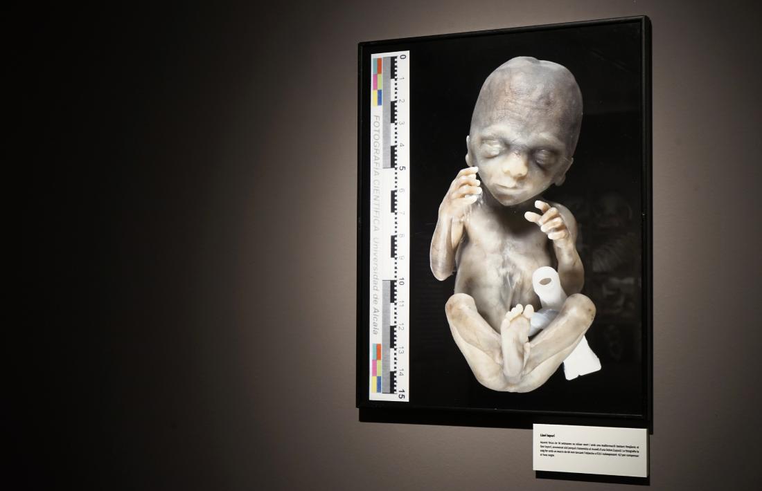 Fotografia mèdica: fetus afectat de llavi leporí mort a les 18 setmanes de gestació.